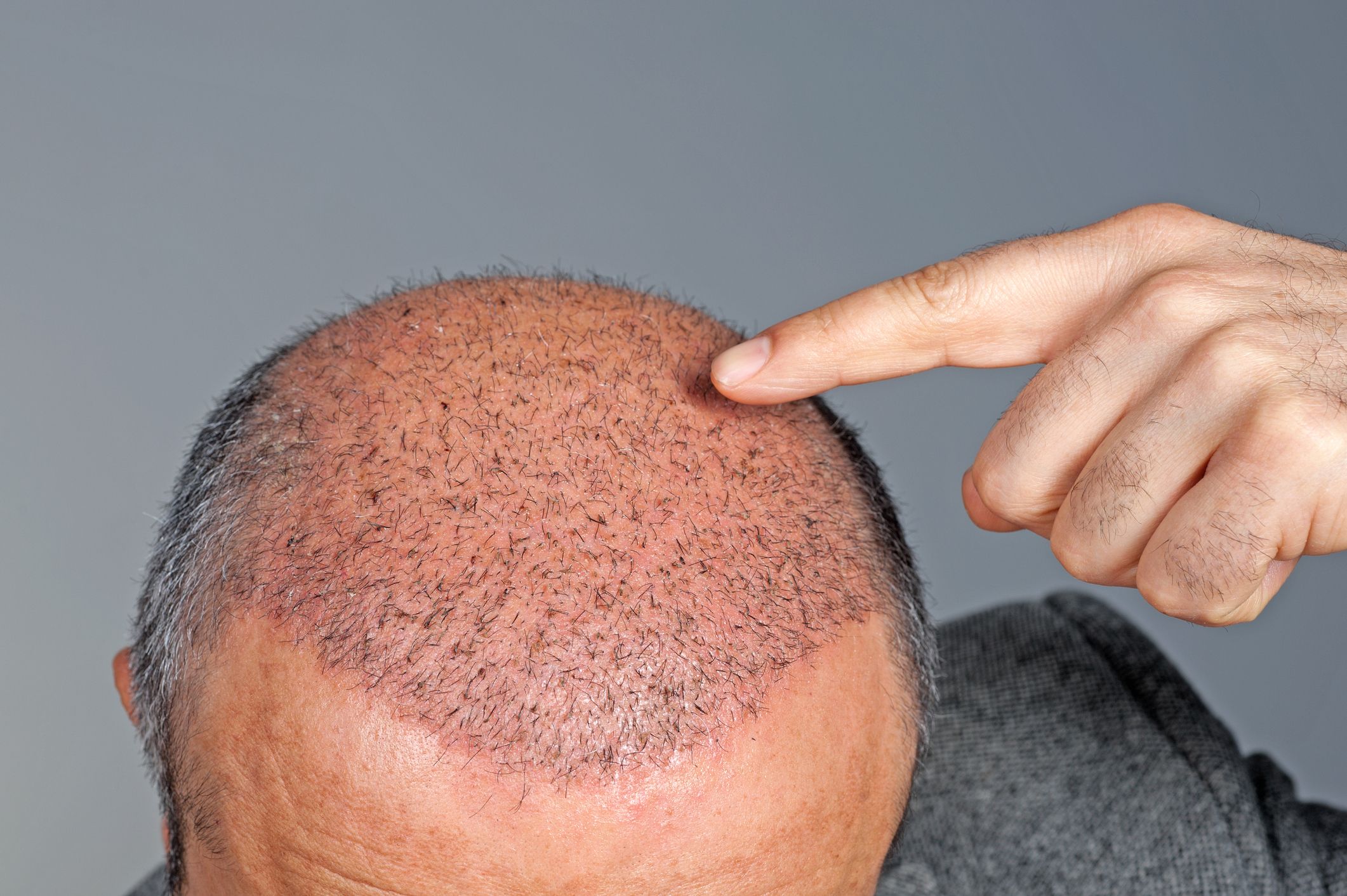 Revive Your Hairline with FUT Hair Transplant