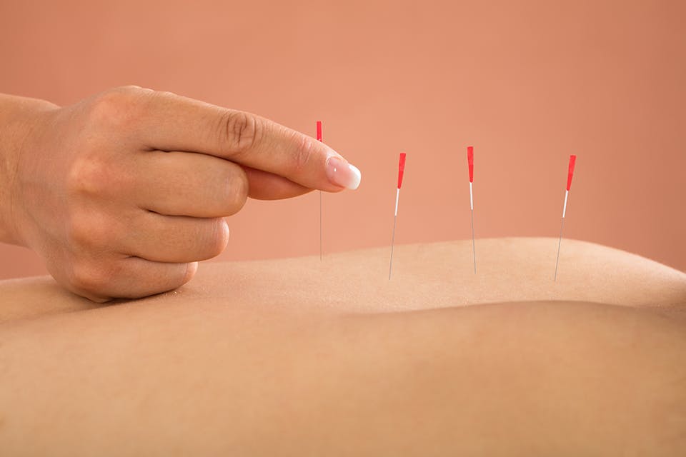 milton acupuncture