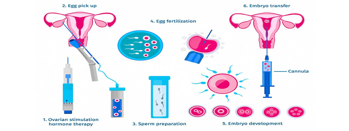 IVF Treatment