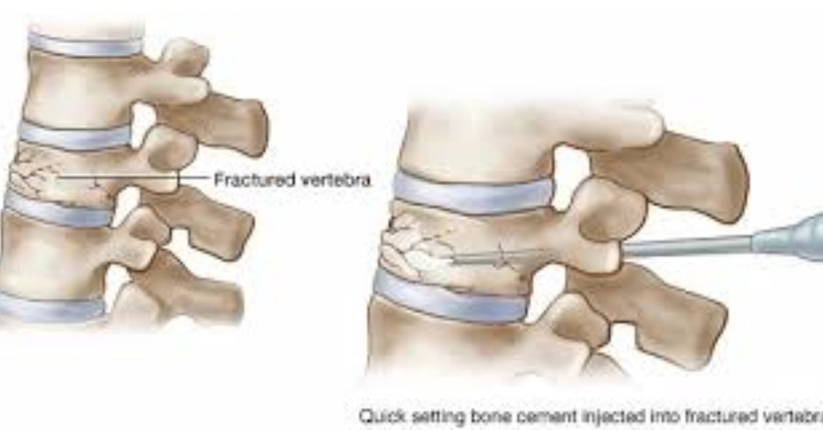 Vertebroplasty