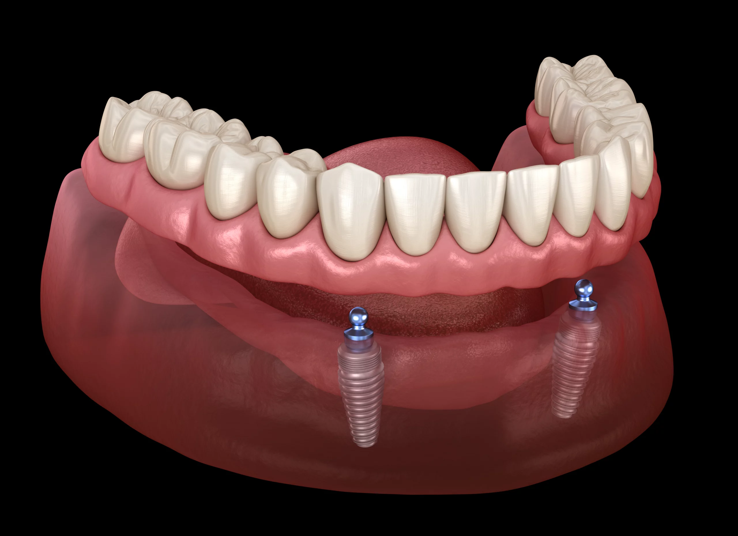 dentures Crawfordville FL