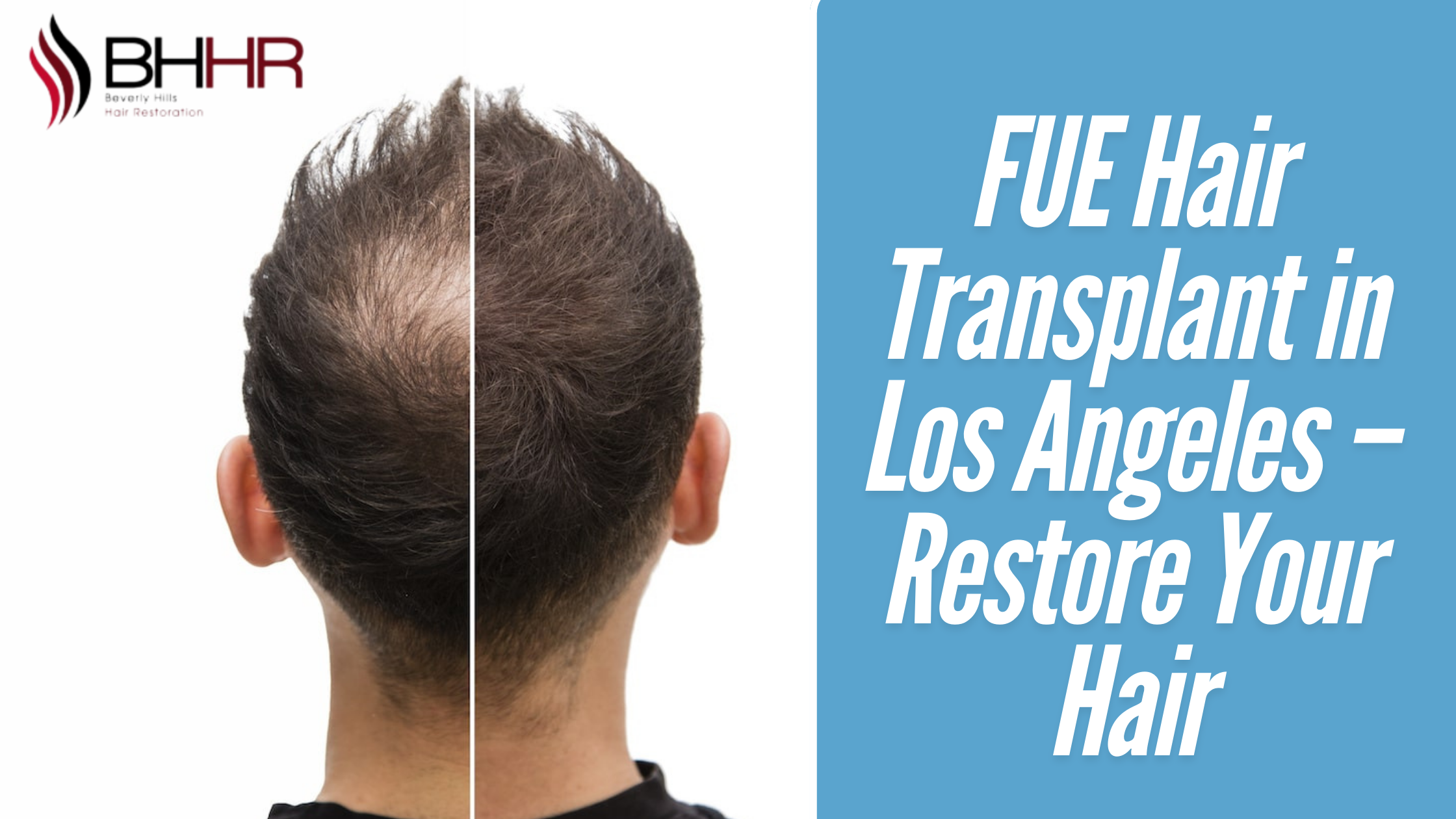 fue hair transplant in Los Angeles