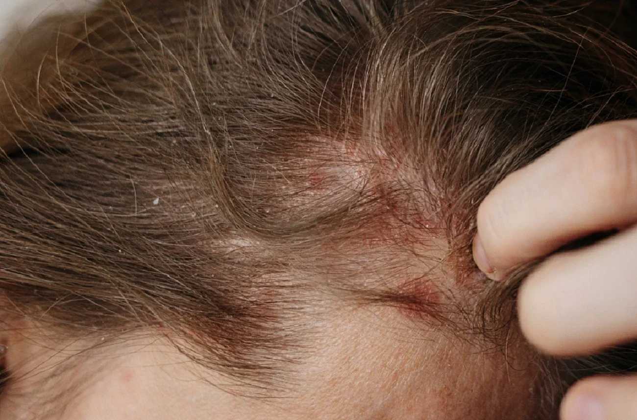 eczema hair thinning