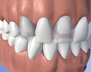 dentures tampa fl