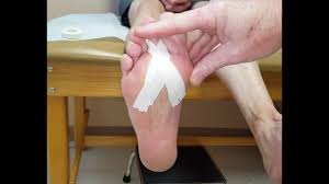 Plantar Plate Tear Taping