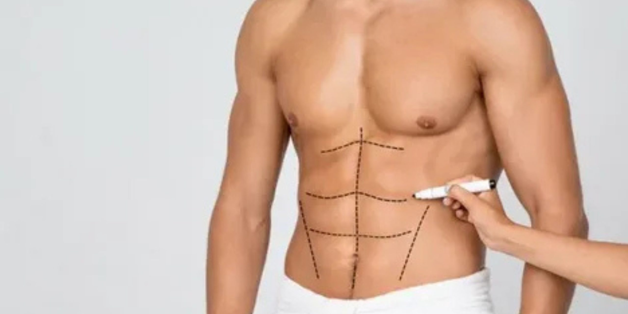 Liposuction in Delhi – Achieve Your Dream Contours with Safe & Effective Fat Removal