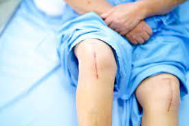 Recovery Tips After Hip and Knee Surgery by Dr. Shohab Hyder in Karachi