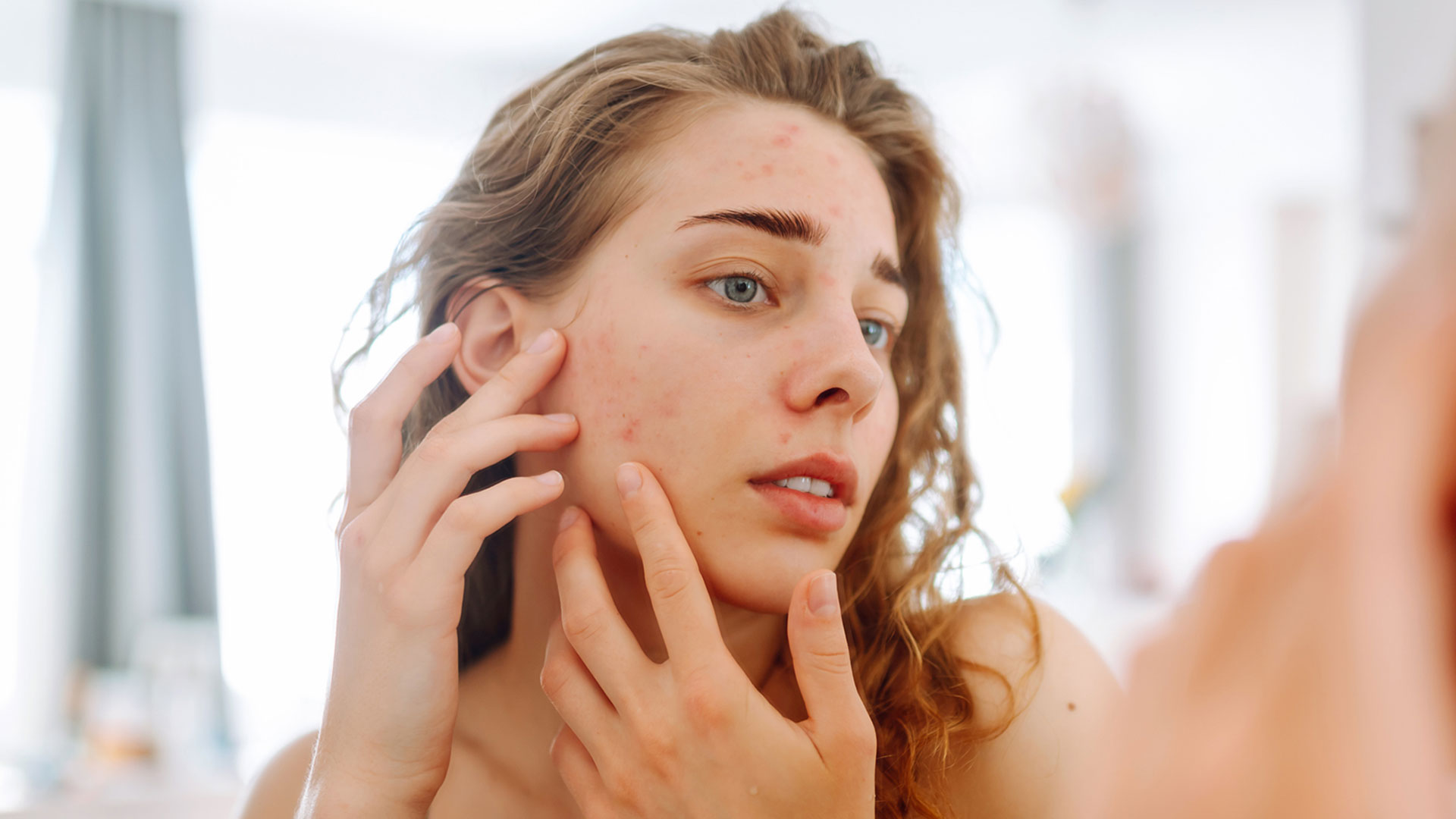 Clear Skin Journey: A Comprehensive Guide to Managing Acne Naturally