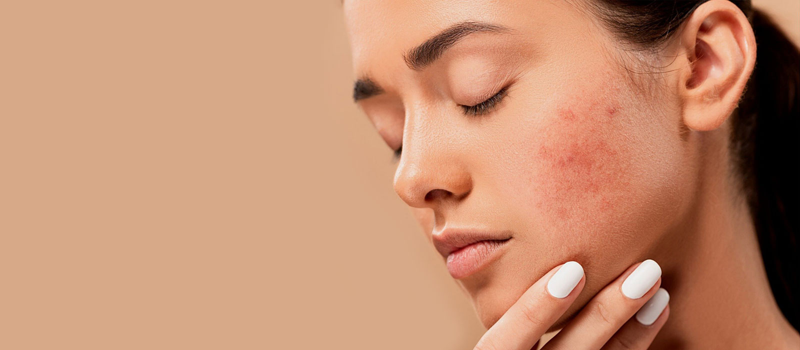 Clear Your Skin with Professional Acne Treatment Vienna