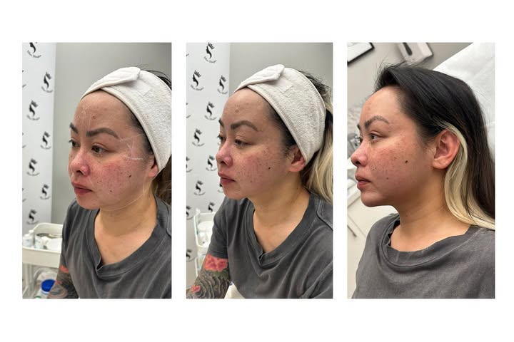7D HIFU Facial Treatment A Revolution in Non-Invasive Skin Lifting