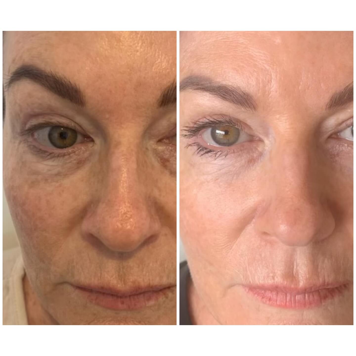 Youthful Radiance The Power of 7D HIFU Facial Treatment