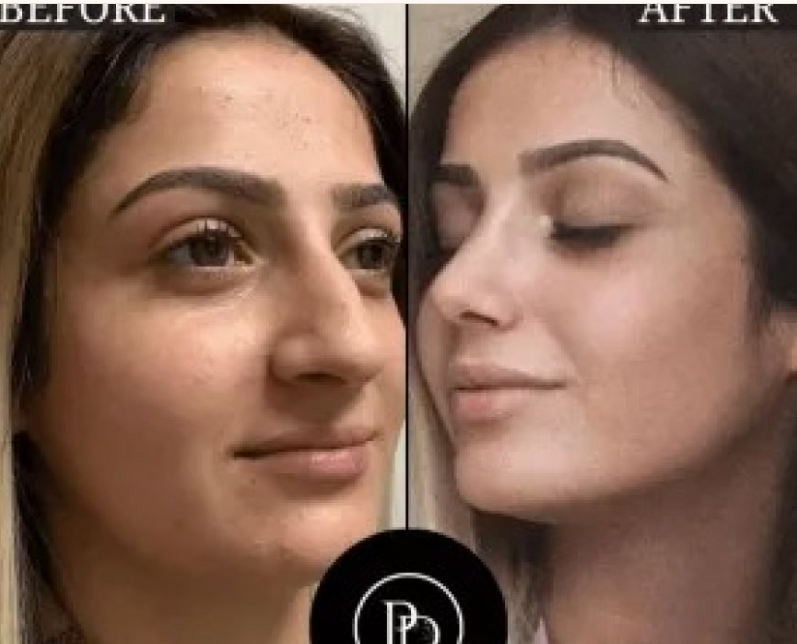 Platelet-Rich Plasma Therapy: Why Dubai Leads in PRP Treatments