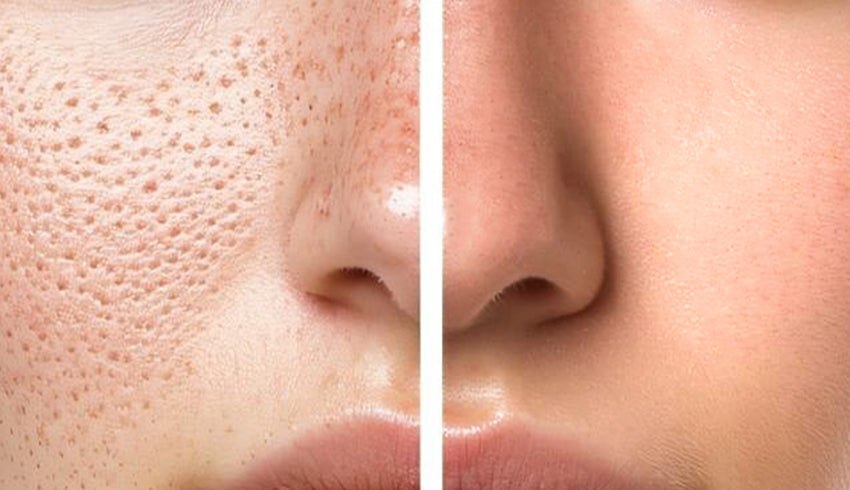 Large pores treatment: Avoid pore-clogging habits