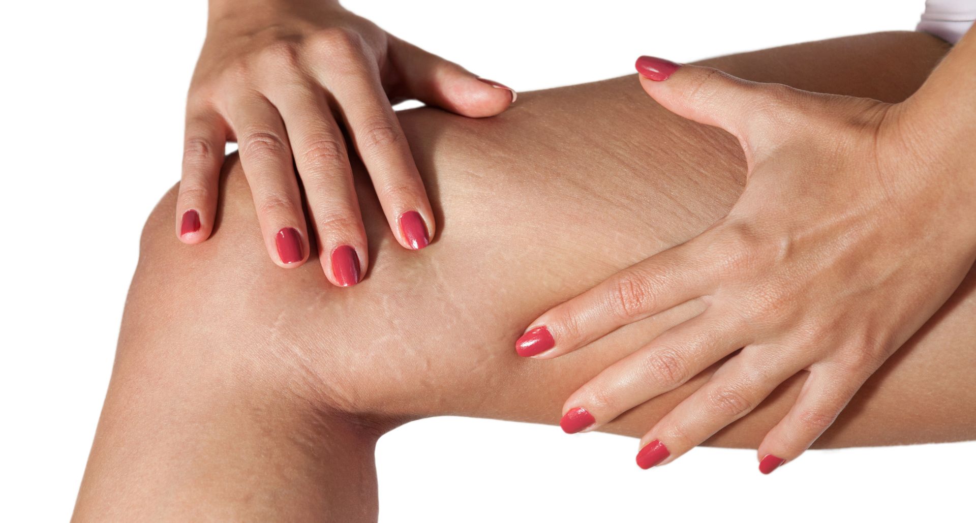 Stretch Marks Removal: Prep Your Skin for Success