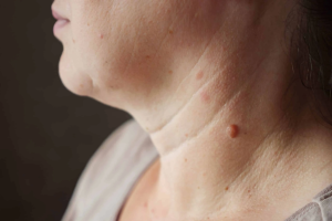 The Truth About Warts Removal Surgery Results