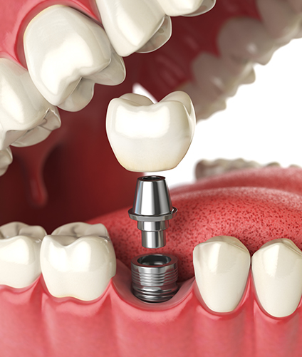 dental implant cost nyc