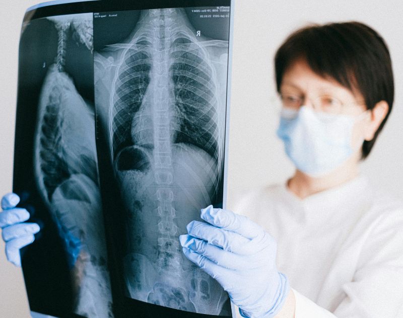 lung cancer stages