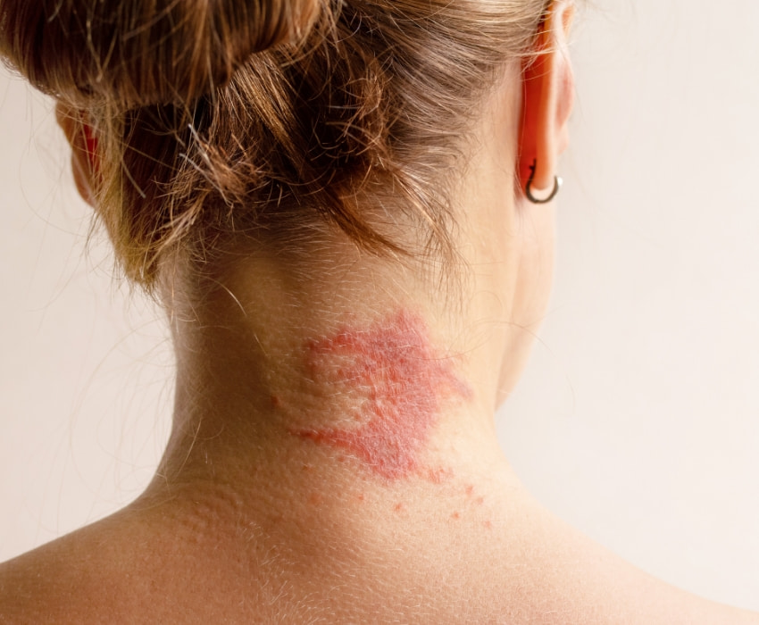 Can a dermatologist treat scalp eczema the right way