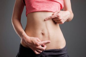 Clear Complexion Achieved by Surgical Scar Revision
