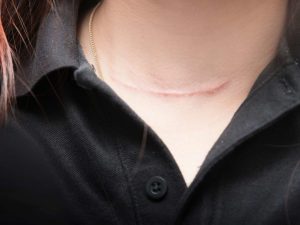 Enhance Your Appearance Through Surgical Scar Revision