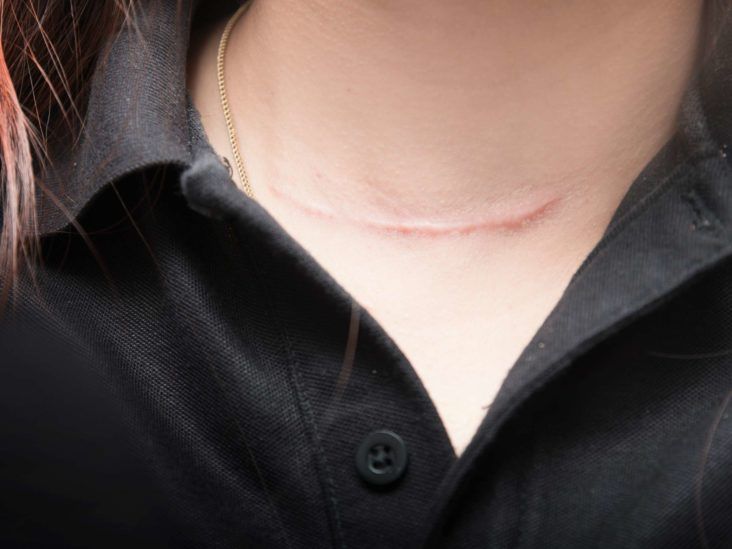 Enhance Your Appearance Through Surgical Scar Revision