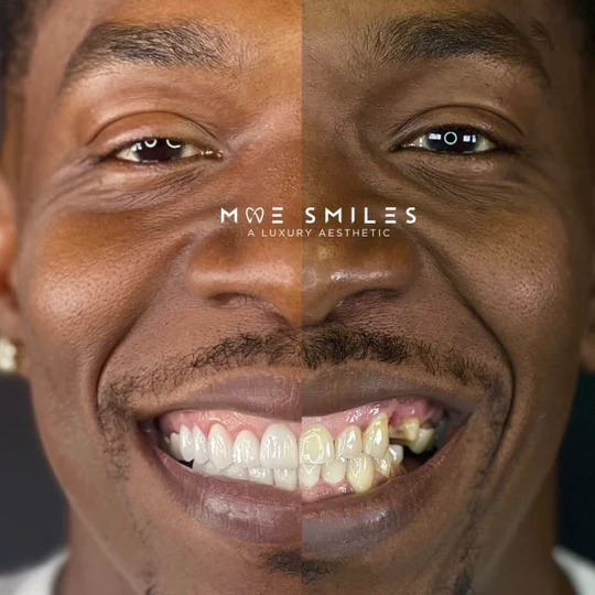 best veneers houston