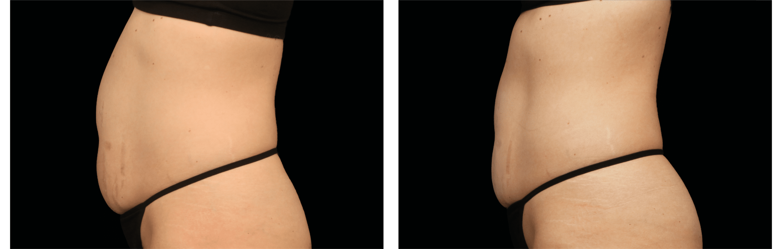 EMTONE Treatment in Clermont, FL
