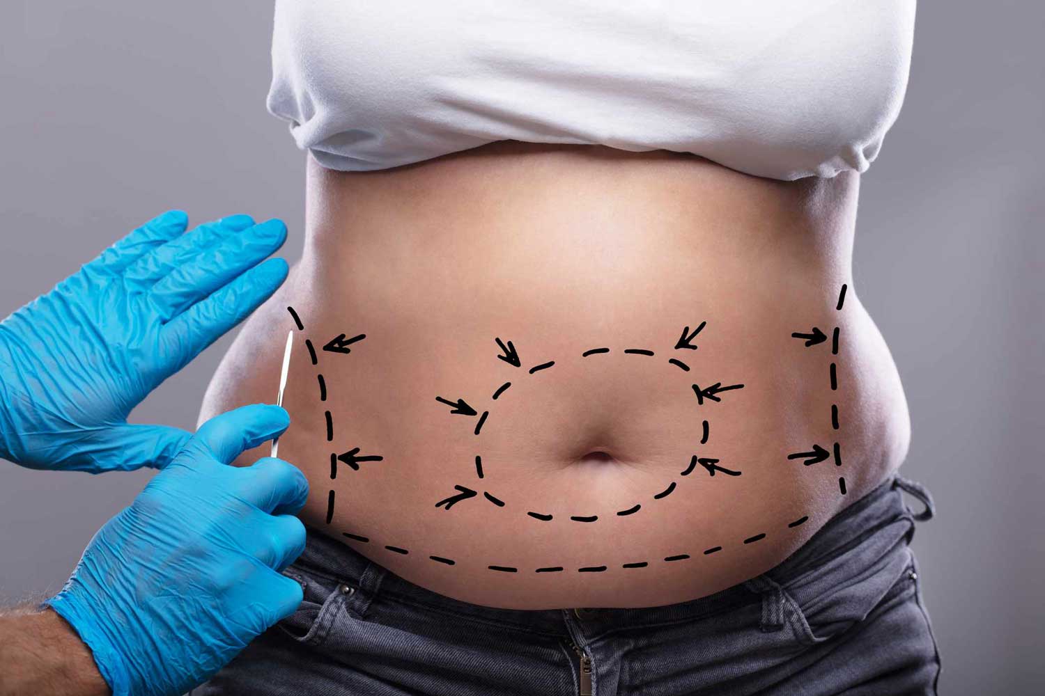 Tummy Tuck Eliminate Sagging Skin Effectively