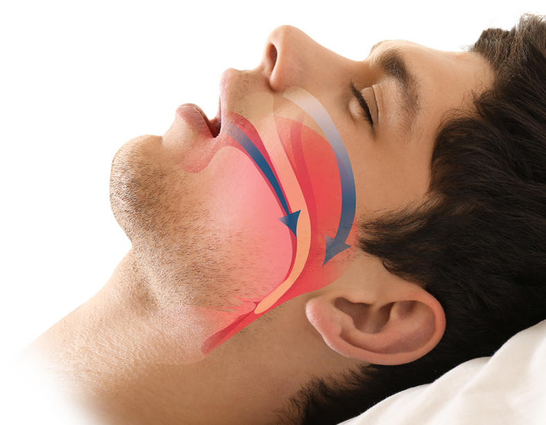 sleep apnea doctor houston