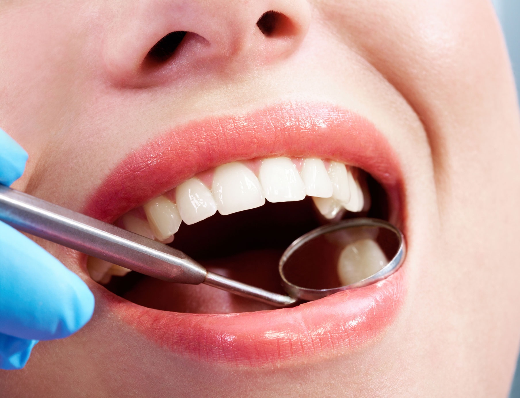 How Do You Choose the Right Veneers Provider in Houston, Texas?