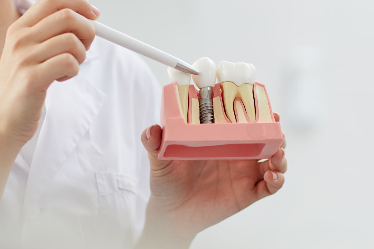 Dental Implants Recovery Timeline What to Expect