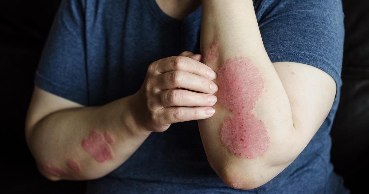 Eczema treatment in surat