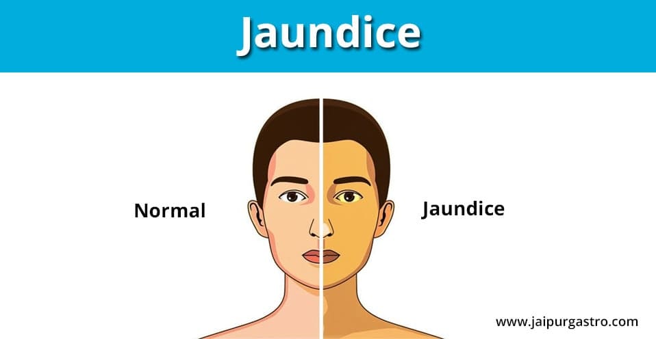 Experienced Doctors for Jaundice Treatment in Jaipur