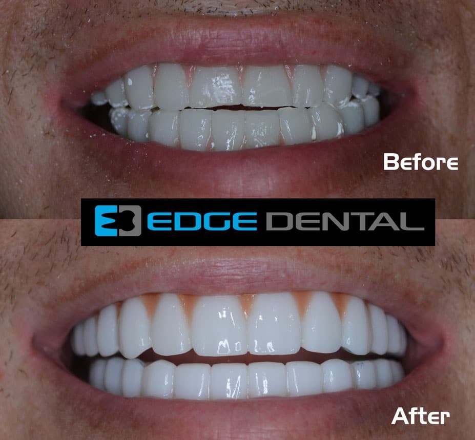 How Do Teeth Transform With Veneers Before and After Treatment?