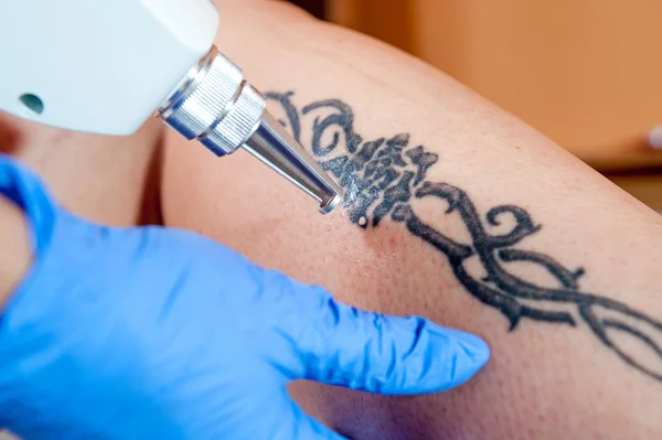 Affordable Tattoo Removal