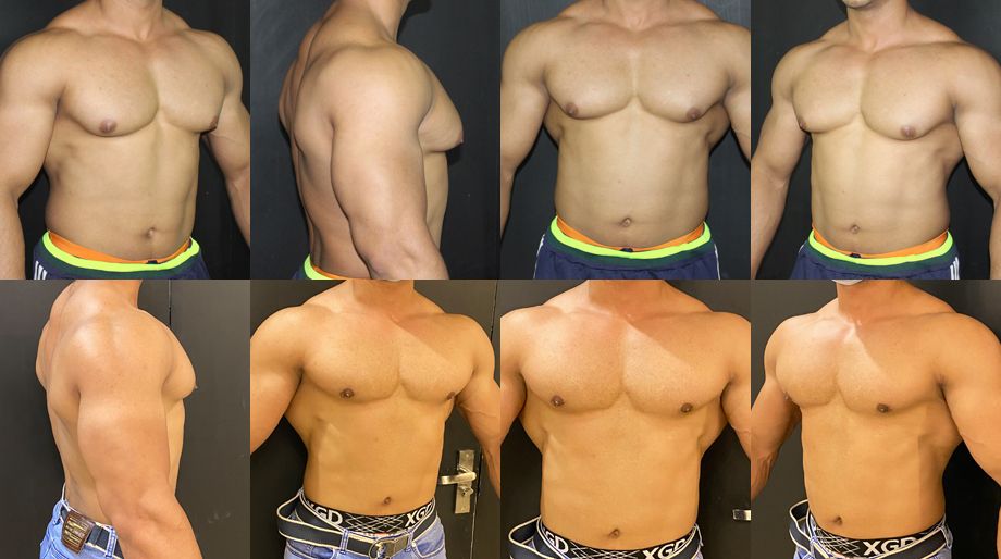 gynecomastia surgery cost in Pakistan
