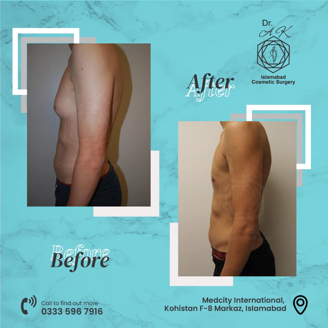liposuction surgery in islamabad