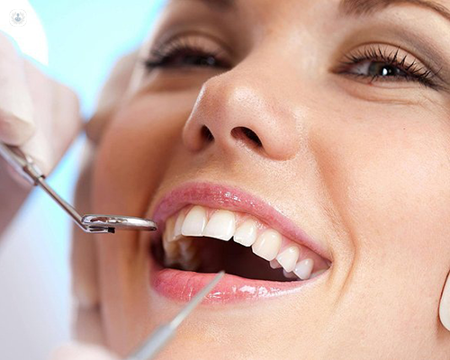 Amalgam Removal Tampa