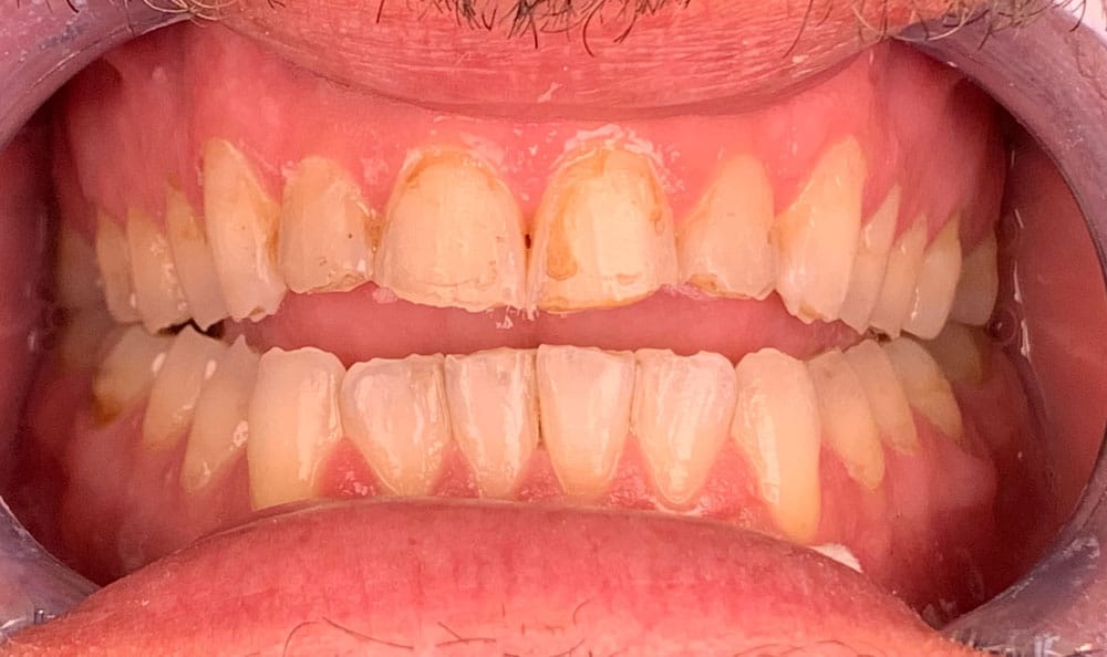 When Is a Dental Abscess Considered a Medical Emergency?