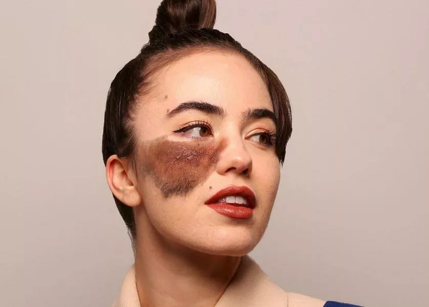 AI-Enhanced Laser Mole Removal in Dubai 2025