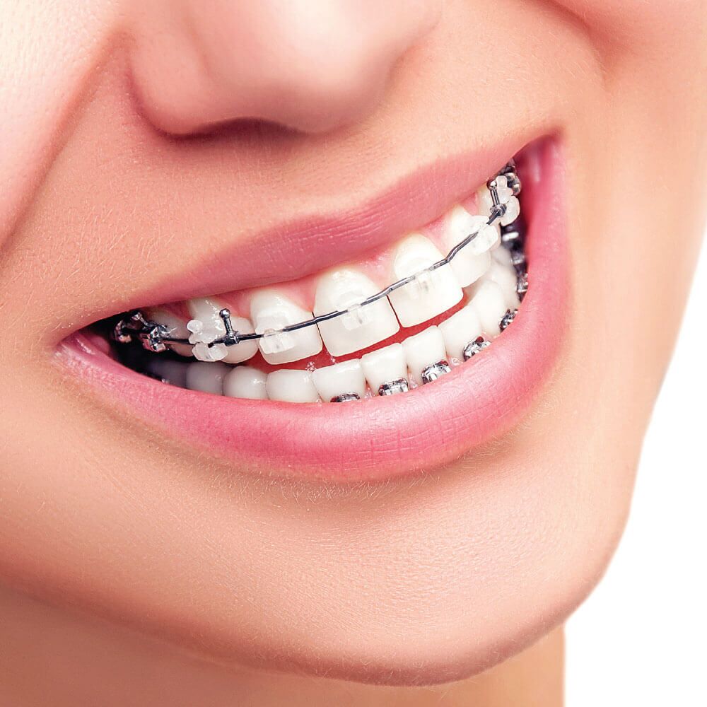 Dental Braces in Dubai: Complete 2025 Guide