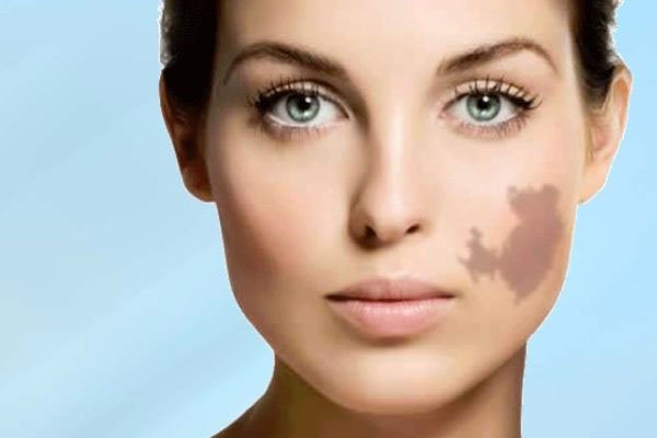 Dubai’s Trusted Birthmark Removal Experts
