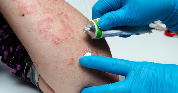 Eczema treatment in surat