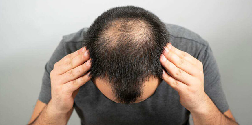 Hair Transplants in Dubai: Choosing the Right Clinic
