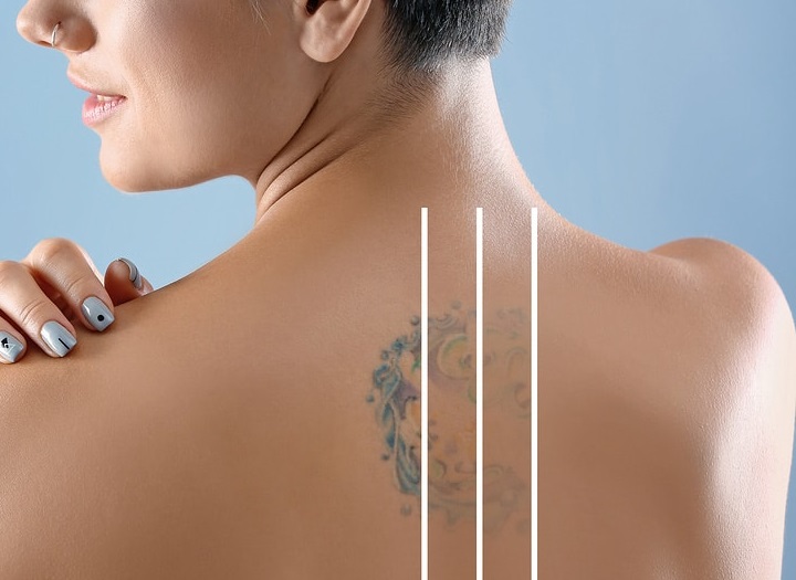 Tattoo Removal in Dubai Affordable Laser Solutions