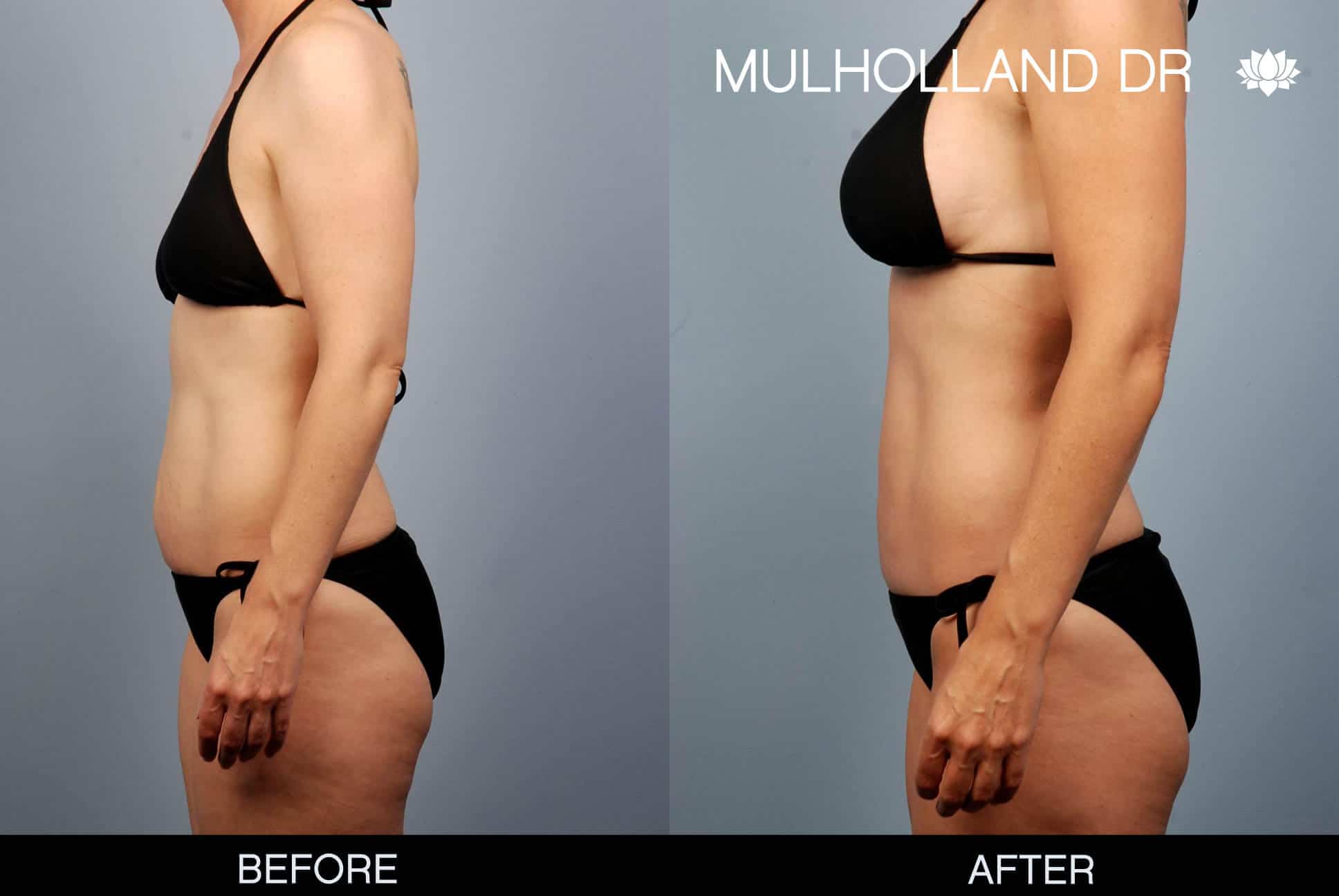 mommy makeover before and after