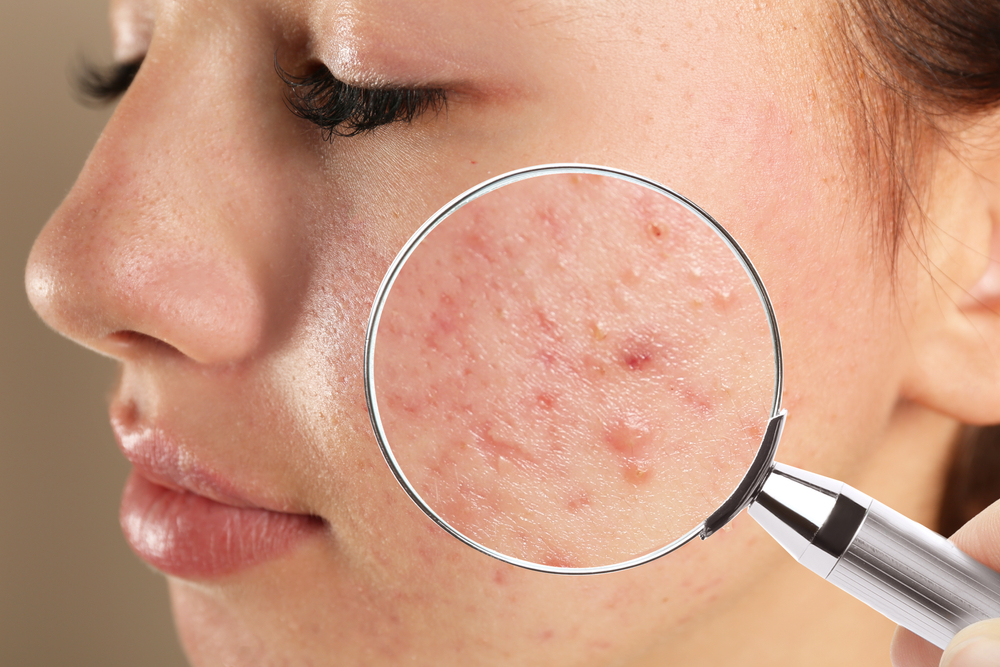 Acne Scar Treatment in Dubai Safe, Fast & Effective